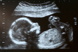 Pregnancy Ultrasound